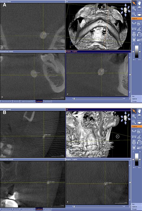 Salivary Calculus Diagnosis With 3 Dimensional Cone Beam Computed