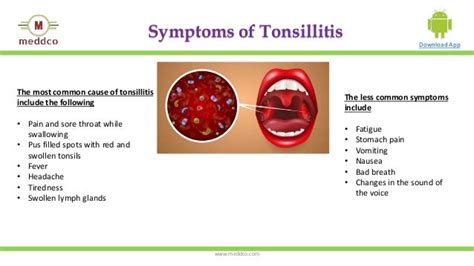 Tonsillitis Typescausessymptomsdiagnosisprevention And Treatment