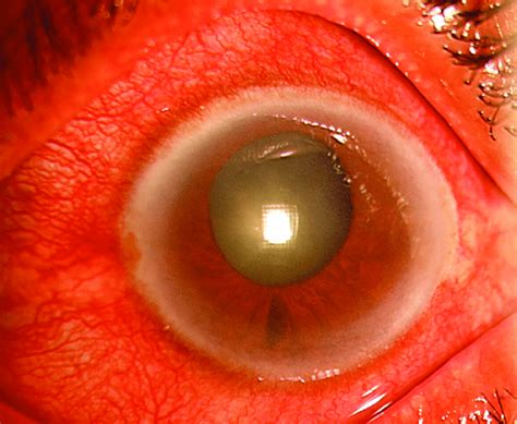 Obstructed aqueous outflow tract → aqueous humor builds up → increased intraocular pressure (iop) → optic nerve damage → vision loss. 3: Acute attack of primary angle closure glaucoma ...