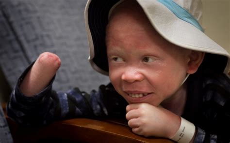 Albino Children Hunted Maimed In Tanzania Now Healing In Philadelphia