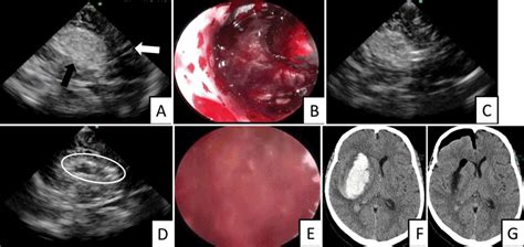 Real Time Ultrasound Guided Endoscopic Surgery For Putaminal Hemorrhage