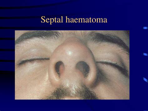 Ppt Nasal Obstruction Powerpoint Presentation Free Download Id9626838