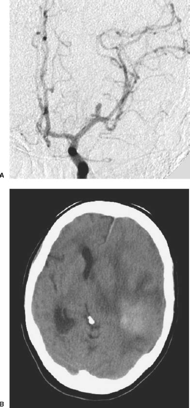 Spontaneous Intracerebral Hemorrhage Neupsy Key