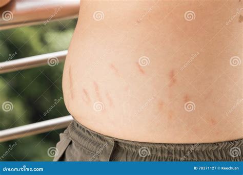 Stretch Marks Or Cellulite On Waist Belly Stock Image Image Of People