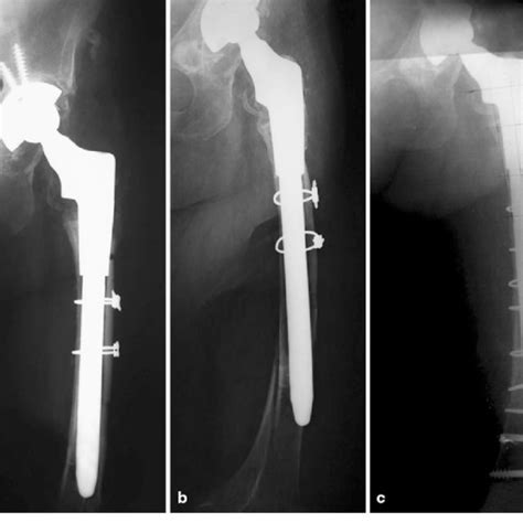 A 49 Year Old Female With Vancouver Type B2 Periprosthetic Femoral