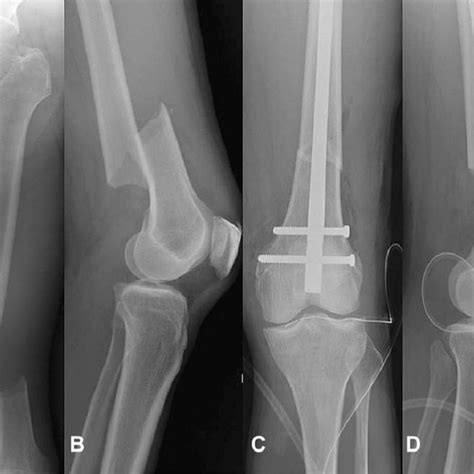 A And B Radiographs Of The Fractured Distal Femur Showing A