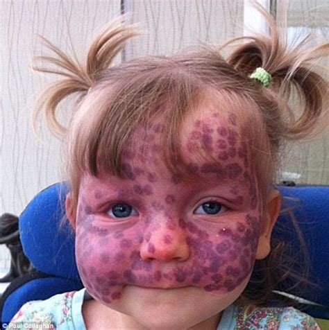 Six Year Old Has Rare Birth Mark Which Covers Her Face And Needs Laser