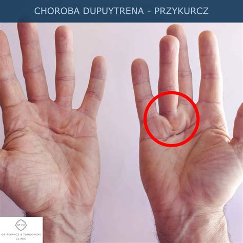 Przykurcz Choroba Dupuytrena Przyczyny Objawy Leczenie Przykurczu My