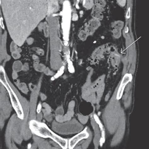 Ct Scan With Intravenous Contrast In The Portovenous Phase Coronal