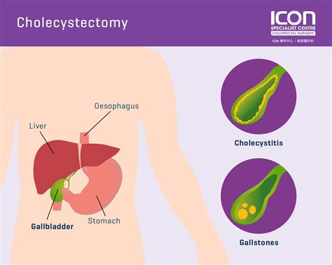 Cholecystectomy Icon Specialist Centre