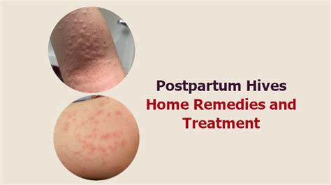 11 Postpartum Hives Home Remedies And Treatment