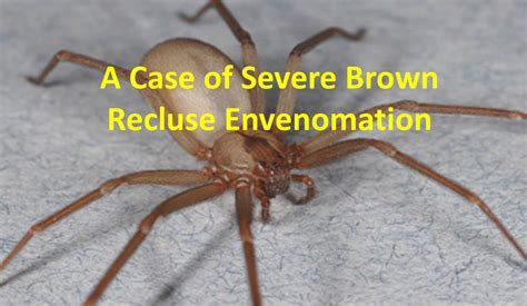 A Case Of Severe Brown Recluse Envenomation Emdocs