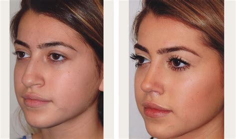 Rhinoplasty Before And After Nose Job Before And After