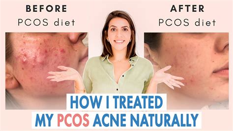 How I Healed My Cystic Acne Naturally Pcos And Hormonal Acne Youtube