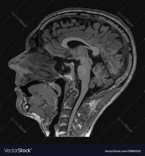 Realistic Image Sagittal Of Male Head With Ct Scan
