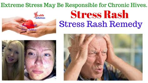 Stress Rash Stress Rash Remedy Extreme Stress May Be Responsible