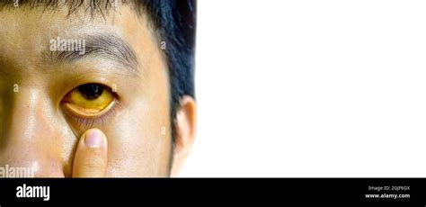 Deep Jaundice In Asian Male Patient Yellowish Discoloration Of Skin