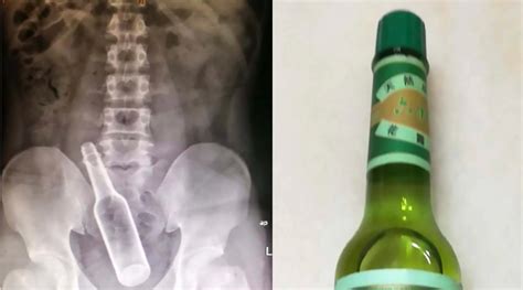 Man Has Seven Inch Glass Bottle Removed From Rectum After Using It To ‘scratch An Itch’ Rare
