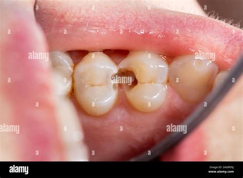 Dental Caries Filling With Dental Composite Photopolymer Material