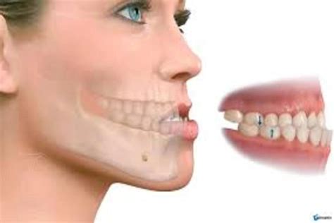 ¿qué es la mandíbula desviada clinica dental sonrisa segura