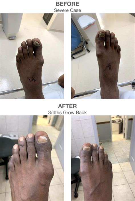 Toenail Removal Pictures