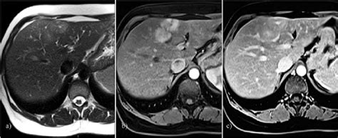 Abdominal Mri A T2 Weighted Mri Showed Slightly Hyperintense Lesions