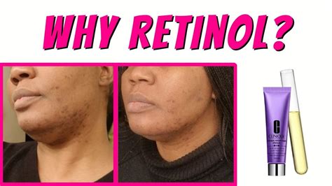 Is Retinol Good For Acne Scars Retinol Review Clinique Smart