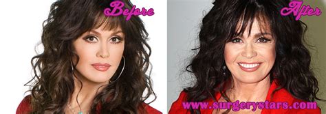 Marie Osmond Plastic Surgery Before And After Surgery Photos