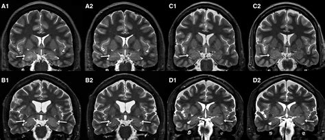 Suspected New‐onset Autoimmune Temporal Lobe Epilepsy With Amygdala