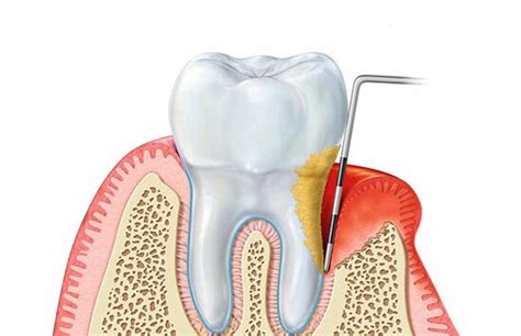 Parodontologia Significato Cause Sintomi E Cure