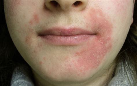 Perioral Dermatitis Cure Signs Risks And Everything You Need To Know