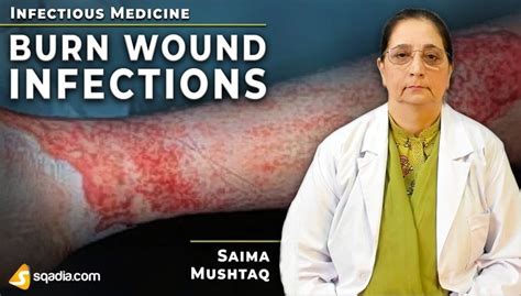 Burn Wound Infections