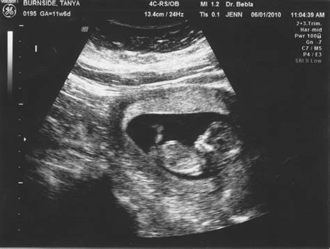 Scott And Tanyas Pregnancy Blog 12 Week Sonogram