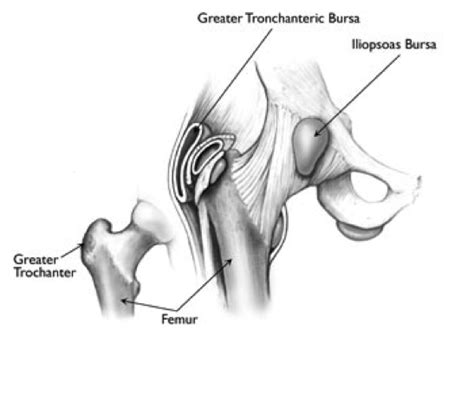 Hip Bursitis Ortho Illinois