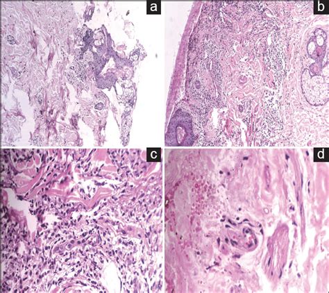 Eosinophilic Granulomatosis With Polyangiitis Presenting As Acute Nasal