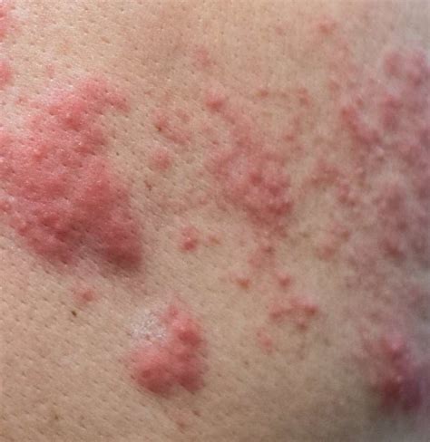Shingles And Hiv What Is The Link