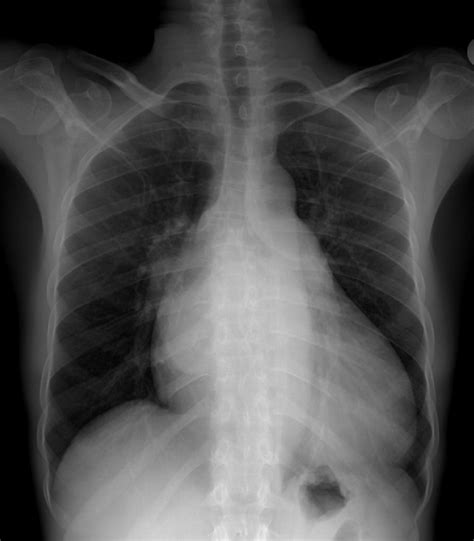 X Ray Chest Pa View Showing Lv Left Ventricular Enlargement A Large