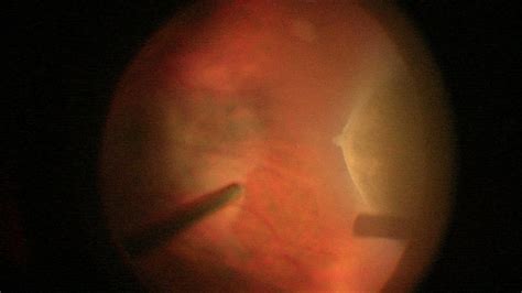 Ora Retinal Cyst Retina Image Bank