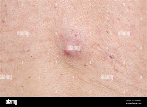 Infected Sebaceous Cyst Centre On The Back Of A 47 Year Old Man