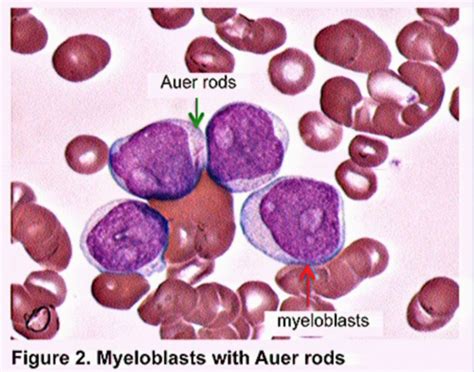 28 Acute Myeloid Leukemia Flashcards Quizlet