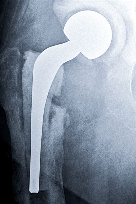 Infected Hip Replacement Adam Sassoon Md Ms