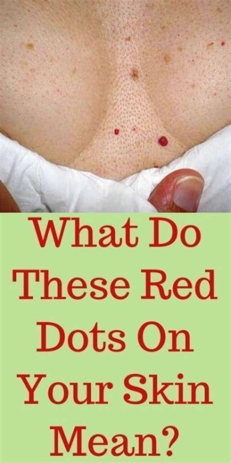 DO YOU HAVE THESE RED SPOTS ON VARIOUS PARTS OF YOUR BODY? SHOULD YOU WORRY? WHAT SHOULD YOU DO ...