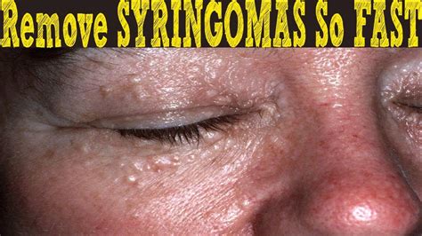 Natural Ways To Remove Syringomas Without Cauterization How To Get