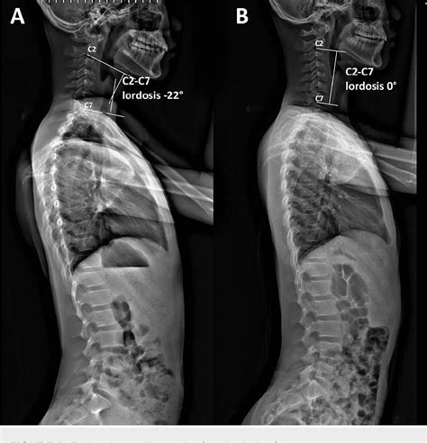 Figure 3 From Scoliosis Causing Cervical Dystonia In A Chiropractic