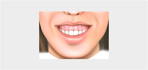 Gummy Smile Mount Elizabeth Orthodontic Clinic