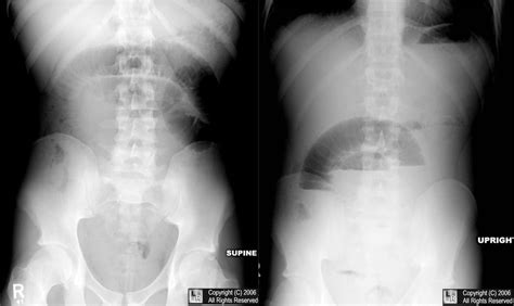 Small Bowel Obstruction Sbo Radiology Radiography Small Bowel