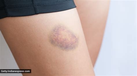 What Are The Reasons Behind Unexplained Bruising On The Body Bollyinside