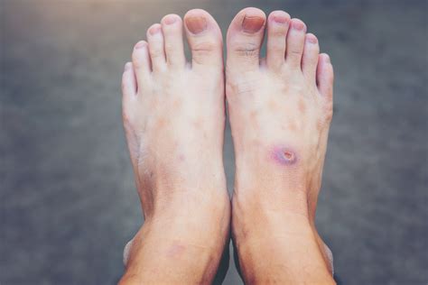 Should You Worry About A Diabetic Foot Ulcer Prevention And