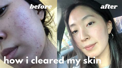 How I Cleared My Skin Skincare For Oily Acne Prone And Sensitive Skin Youtube