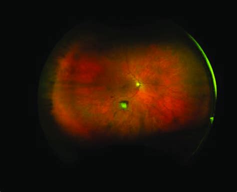 Funduscopic Examination Revealing Retinal Lesions Download